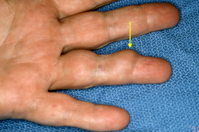 GCTTS left ring finger over middle phalanx (arrow)