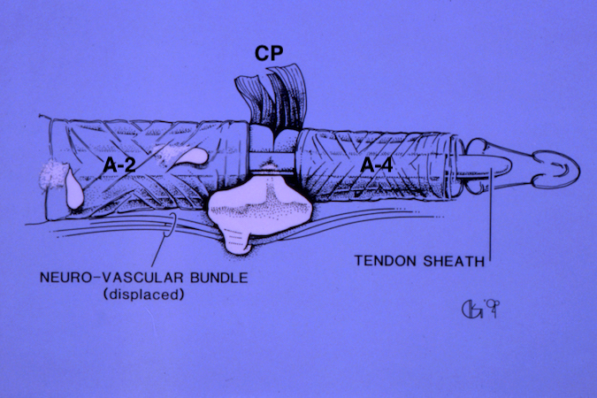 GCTTS invading PIP joint under cruciate pulley and involving the neuromuscular bundle