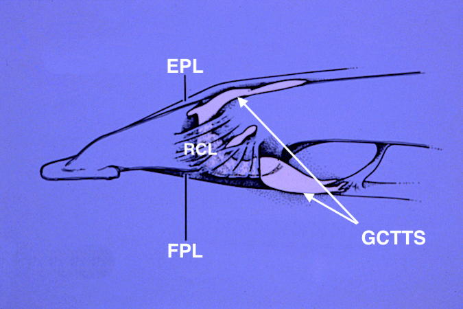 GCTTS invading thumb IP joint with tumor removed.  Note tumor in RCL and radial edge of volar plate. Collateral and edge of volar plate excised.  Collateral reconstructed with a small slip of the FPL.