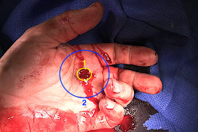 Note the small entry wound (circle 1) and the large area of potential blast effect (circle 2)