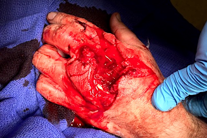 Note the comparably large exit wound caused by the bullet, blast effect and secondary missiles i.e. metacarpal bone fragments