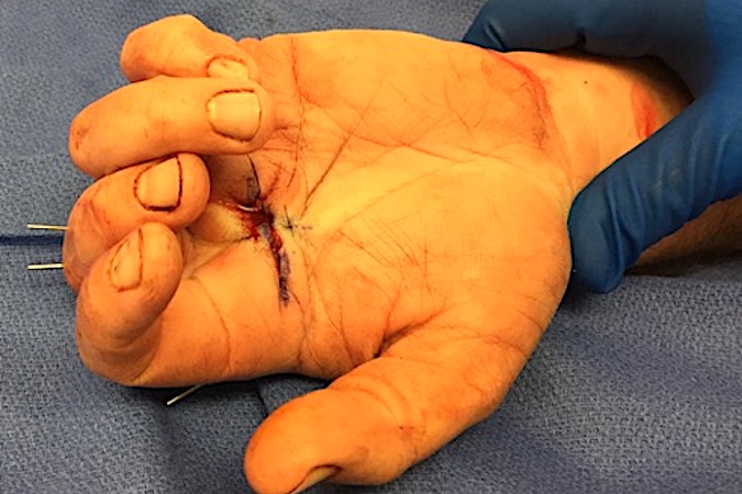 Palm wound closure after irrigation, debridement, soft tissue repair and ORIF of multiple fractures