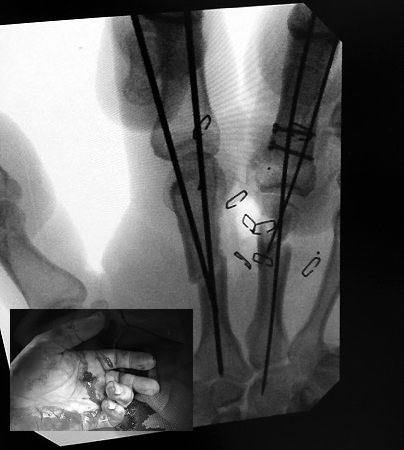 Gunshot wound after irrigation, debridement, soft tissue repair and ORIF of multiple fractures