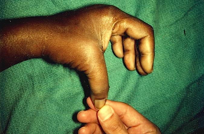 THUMB SPRAIN (GAMEKEEPER'S) | Hand Surgery Resource