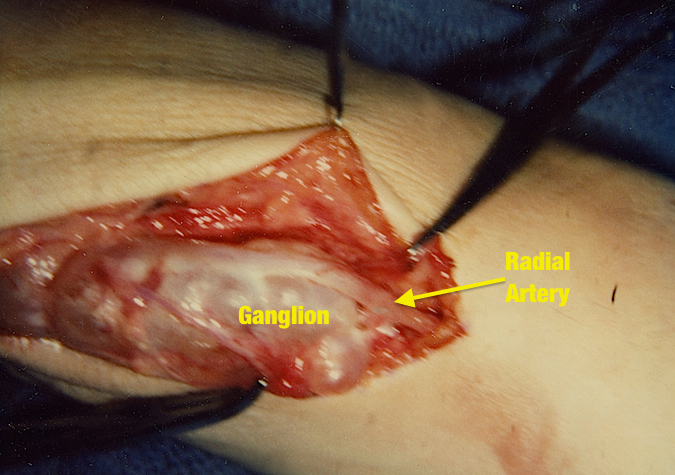 Volar Ganglion adherent to radial artery