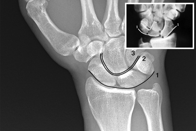 Gilula’s lines (ref 4) superimposed on a neutral deviation PA wrist x-ray.  Arc 1 is a smooth arcing line paralleling the proximal articular surfaces of the triquetrum, lunate, and scaphoid.  Arc 2 parallels the distal concave surfaces of the triquetrum, lunate, and scaphoid.  Arc 3 parallels the smooth curved surface of the proximal hamate and capitate.  When these smooth curved lines are irregular, disrupted, or step off it is indicative of a carpal instability or dislocation.  The insert shows the classi