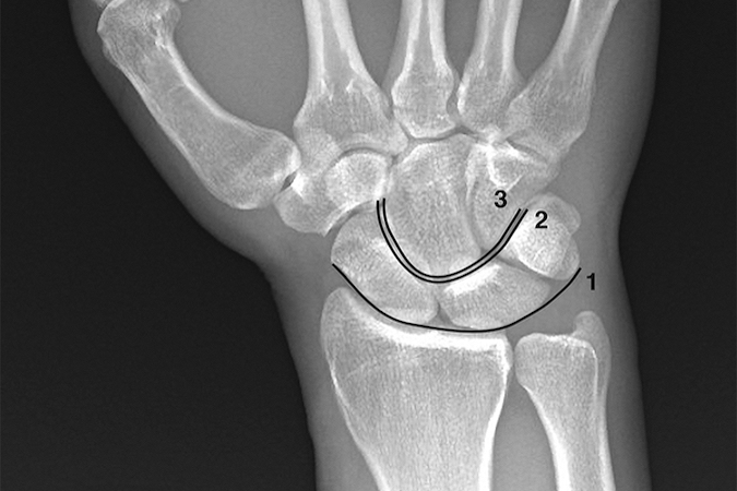 Gilula’s lines (ref 2) superimposed on a neutral deviation PA wrist x-ray.  Arc 1 is a smooth arcing line paralleling the proximal articular surfaces of the triquetrum, lunate, and scaphoid.  Arc 2 parallels the distal concave surfaces of the triquetrum, lunate, and scaphoid.  Arc 3 parallels the smooth curved surface of the proximal hamate and capitate.  When these smooth curved lines are irregular, disrupted, or step off it is indicative of a carpal instability or dislocation.