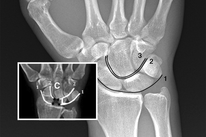Gilula’s lines (ref 5) superimposed on a neutral deviation PA wrist x-ray. Arc 1 is a smooth arcing line paralleling the proximal articular surfaces of the triquetrum, lunate, and scaphoid. Arc 2 parallels the distal concave surfaces of the triquetrum, lunate, and scaphoid. Arc 3 parallels the smooth curved surface of the proximal hamate and capitate. When these smooth curved lines are irregular, disrupted, or step off it is indicative of a carpal instability or dislocation. The insert shows the classic dis