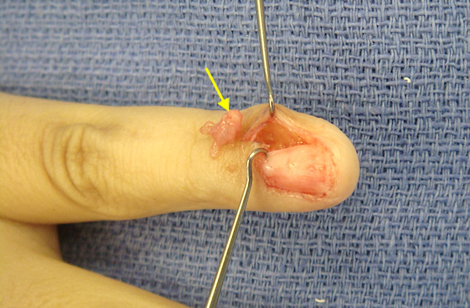 Left little finger glomus tumor excised (arrow)