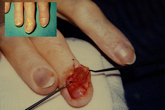 Right long finger glomus tumor excision