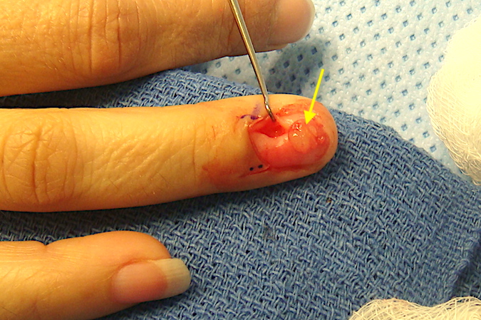 Right ring finger glomus tumor with glomus (arrow) excised
