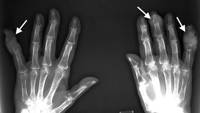 Severe tophaceous gout with joint destruction and bone loss