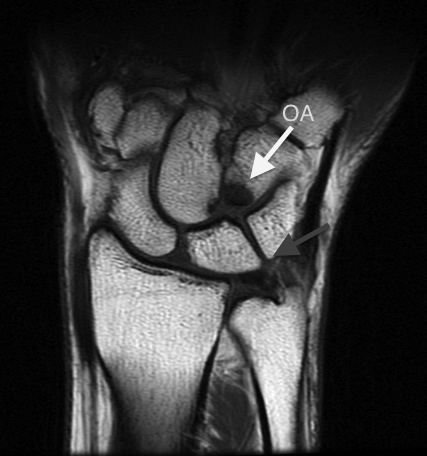 MRI showing Hamate Arthrosis (white arrow) and L-T ligament tear (gray arrow)