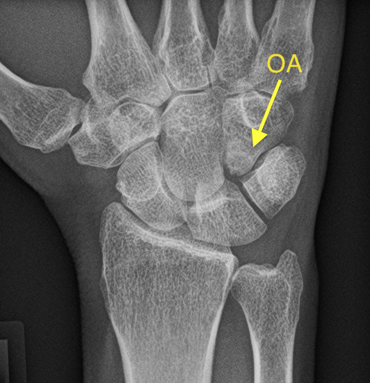 Hamate Arthrosis (HALT Syndrome) note on X-ray at arrow