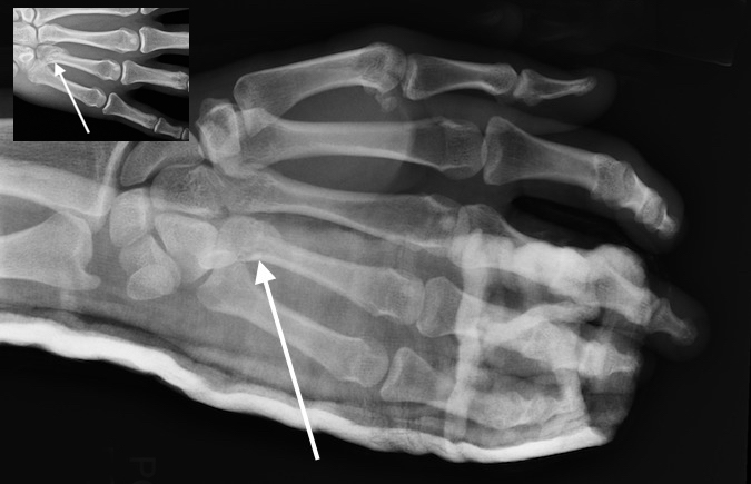  Ring metacarpal base fracture (arrow). Treated in plaster splint.