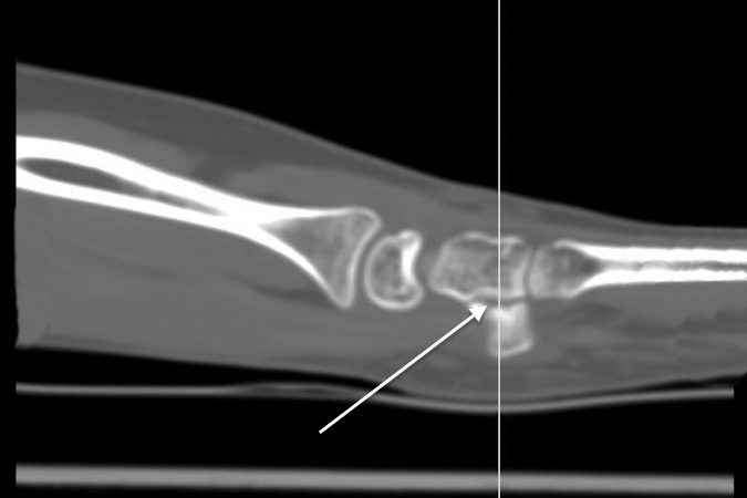 CT Scan sagittal images do demonstrate the hook of hamate fracture (arrow)