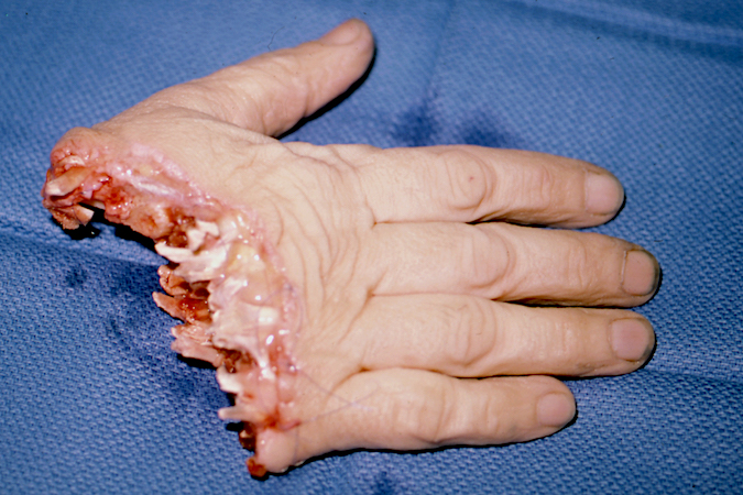 Right hand amputation (dorsal view) from a home table saw accident