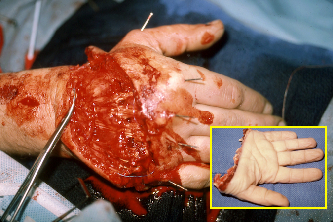 Right hand replant just before final vein repair. Note pins in metacarpals for ORIF and repaired extensors.