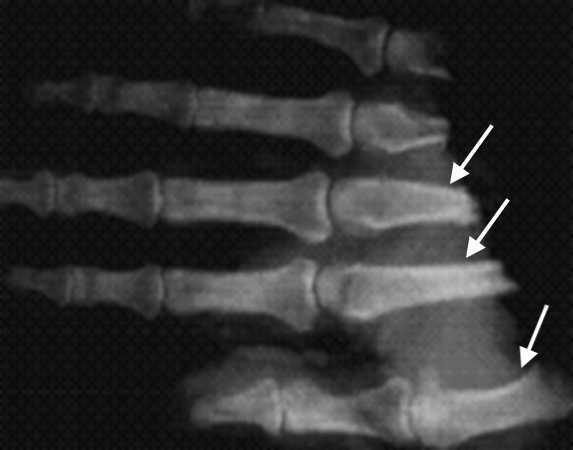 X-ray of hand amputation distal part. Note arrows at sites for bone shortening prior to replantation surgery.