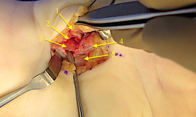 Initial dissection and initial exposure of the hook of the hamate has been done.  The ulnar neurovascular bundle (1) is exposed. The periosteum (2) has been dissected off the hook of the hamate (3).  The hypothenar muscle origins (4) have been released from the hook.  The radial periosteum is being stripped of the hook and the flexors tendons (5) are retracted.