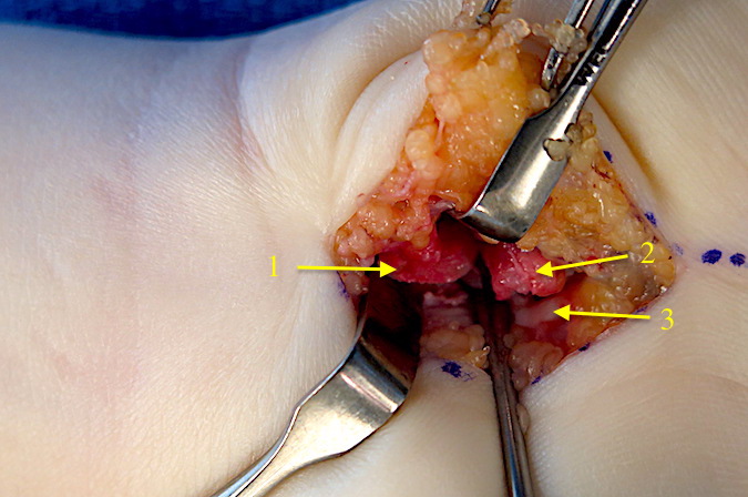 Hook of Hamate (1) exposure complete.  The hypothenar muscle origins (2) have been released from the hook.  The flexors tendons (3) are retracted.