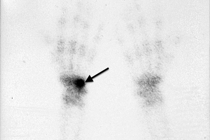 Bone Scan shows marked increased up-take at the site of the hook of hamate fracture  (arrow)