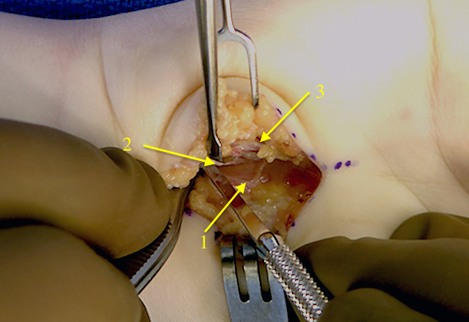 Beaver blade removing ulnar periosteum (2) off the hook of the hamate (1).  Ulnar neurovascular bundle (3) visible.