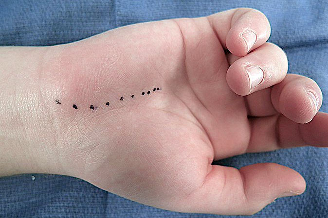 Carpal tunnel incision for excision of the hook of the hamate. Incision will be opened from distal to proxima,l starting at the distal end of the carpal tunnel and Guyon's Canal.  The transverse carpal ligament will be incised proximally until the radial aspect of the hamate is exposed.  Guyon's canal will be opened with transectiion of the pisohamate ligament and exposure of the ulnar nerve and artery.