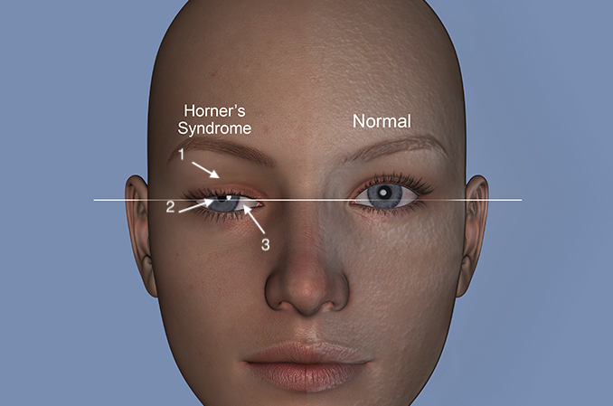 Horner’s sign is frequently associated with C8 and T1 root avulsions which also damage the sympathetic fibers to the face and may produce an ipsilateral Horner’s sign: 1) Ptosis (drooped eyelid); 2) meiosis (constricted pupil); 3) enophthalmos (sunken globe).  Horner’s sign is associated with anhydrous of the ipsilateral face and a poor prognosis when connected with a brachial plexus injury.