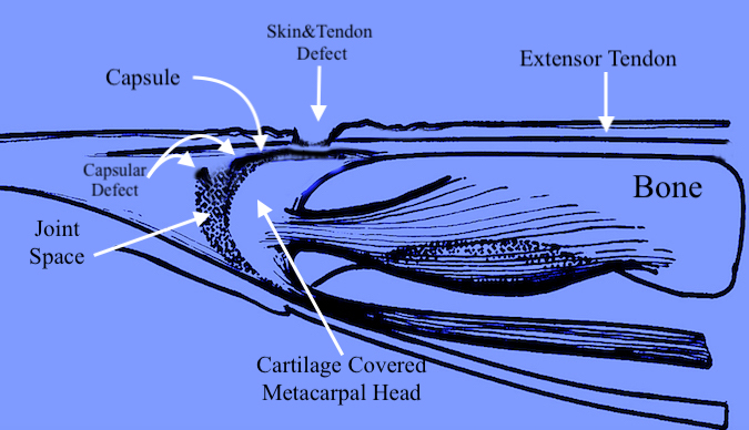 When the patient presents in the ER for examination of the now extended finger, the defect in the skin and extensor tendon has retracted proximally over intact joint capsule thus sealing bacteria in the joint and hiding the capsular defect.