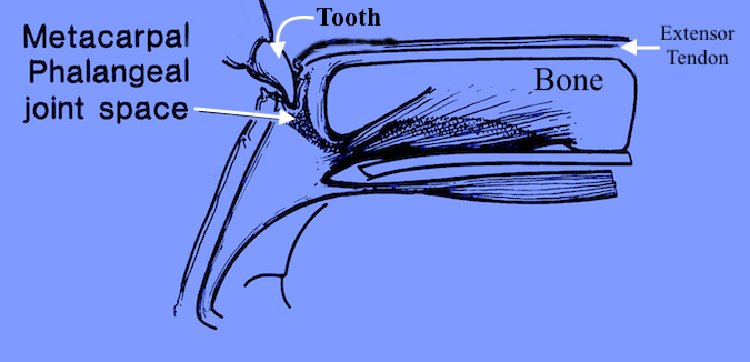 Human Bite - Punch or Fighter's Bite with tooth going through skin, extensor tendon and joint capsule. This inoculates of joint space with bacteria.