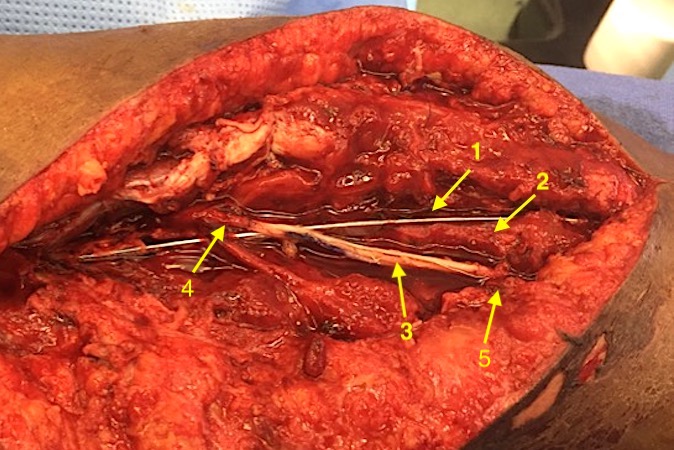 Sural nerve grafting of radial laceration with large true nerve gap.  Plate on humerus for fracture ORIF(1);  Humerus distal end (2).;  Sural nerve grafts (3);  Proximal radial nerve (4);  Distal radial nerve (5).