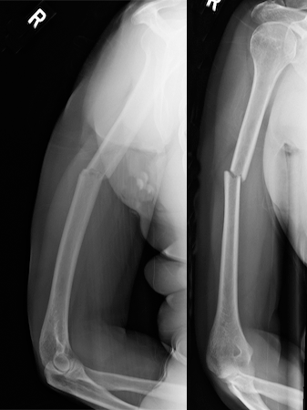 Closed right transverse mid-shaft minimally displaced humerus fracture