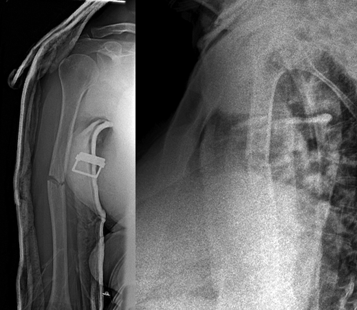 Humerus fracture treated with a coaptation splint.