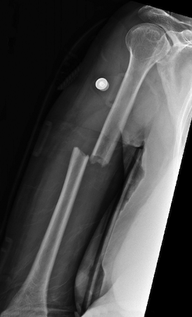 Humerus fracture with 100% displacement