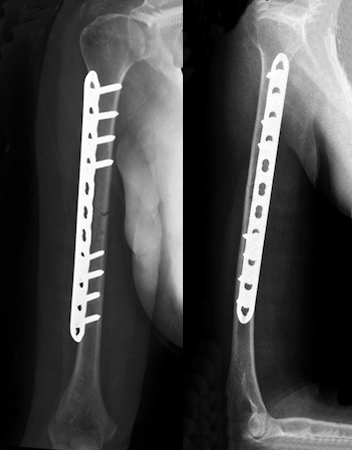 Displaced humerus fracture treated with open reduction and internal fixation (ORIF) with plate and screws.