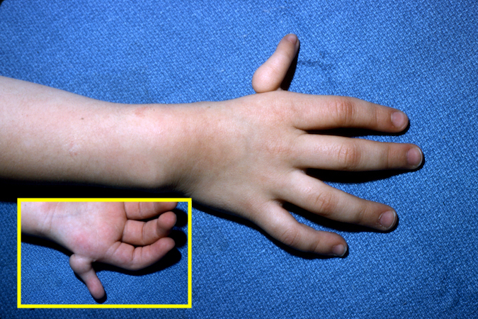 Right Hypoplastic Thumb Type 4 (dorsal and palmar views)