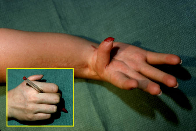 Right Hypoplastic Thumb Type 3A after reconstruction.  Note limited functional value (insert).