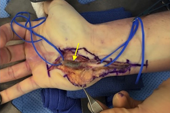 Ulnar artery thrombosis secondary hypothenar hammer syndrome