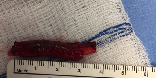 Ulnar artery thrombosis post excision