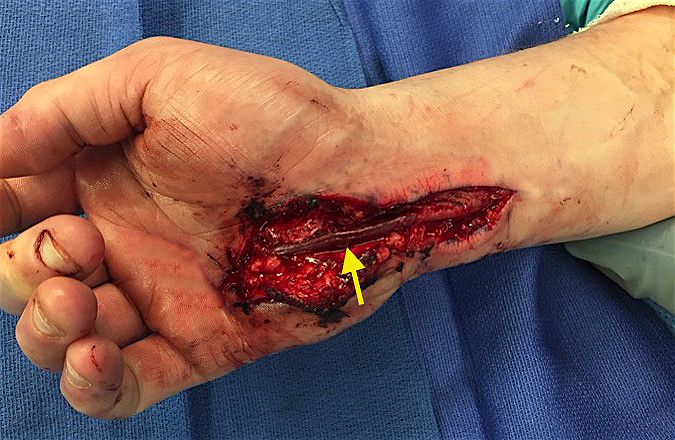 Ulnar artery thrombosis post vein grafting