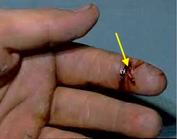 Left index grease gun injection injury 36 hours after accident.