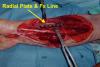 Right radial plate and compressed fracture line