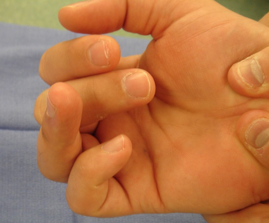 Note lack of DIP joint flexion when tenodesis affect is used to flex the football player's fingers