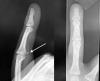 X-ray of ringer finger jersey finger injury with avulsion fracture fragment (arrow) caught at the level of  PIP vincula and chiasma of Camper