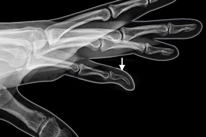 Kirner's Deformity of distal phalanx (arrow)