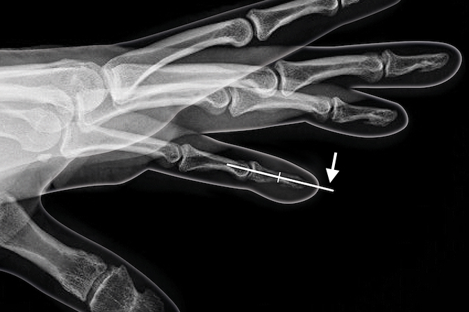 Kirner's Deformity of distal phalanx corrected by a closing wedge osteotomy internally fixed with a K-wire. (arrow)
