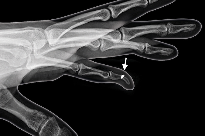 Kirner's Deformity of distal phalanx with closing wedge osteotomy outlined. (arrow)