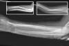 AP X-ray of left double bone forearm fractures closed reduced and immobilized initially in a sugar tong splint. 