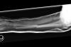 Lateral  X-ray of left double bone forearm fractures closed reduced and immobilized initially in a sugar tong splint. 